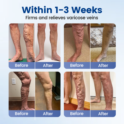 Timilk® Vein Ease Microneedle Therapy Patch - Fast ⚡Effective 💪 and Non-Invasive 🚫 Treatment for Varicose Veins & Leg Swelling 👣