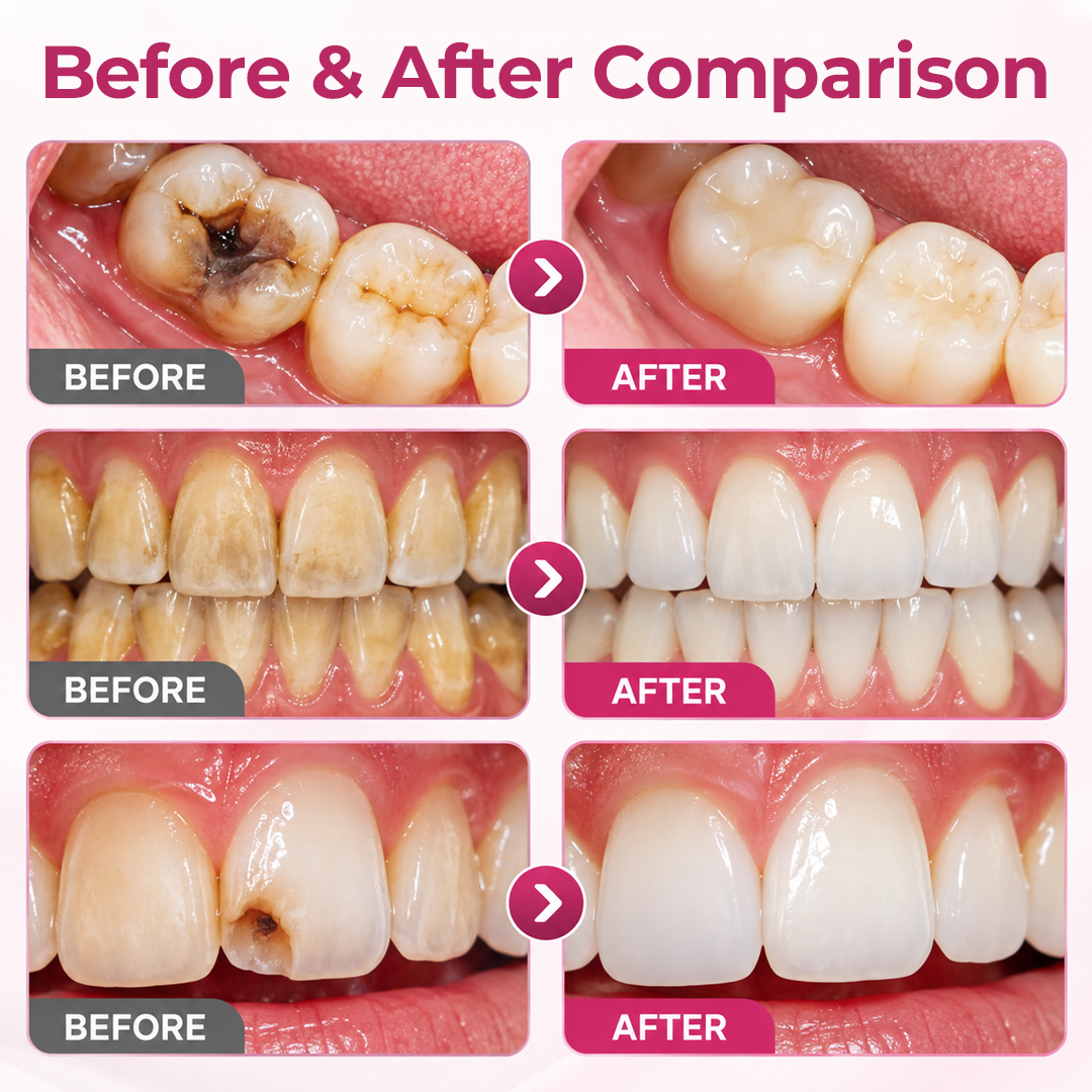 Timilk® DenPerm Cavity-Repair Natural Enamel Filling Gel