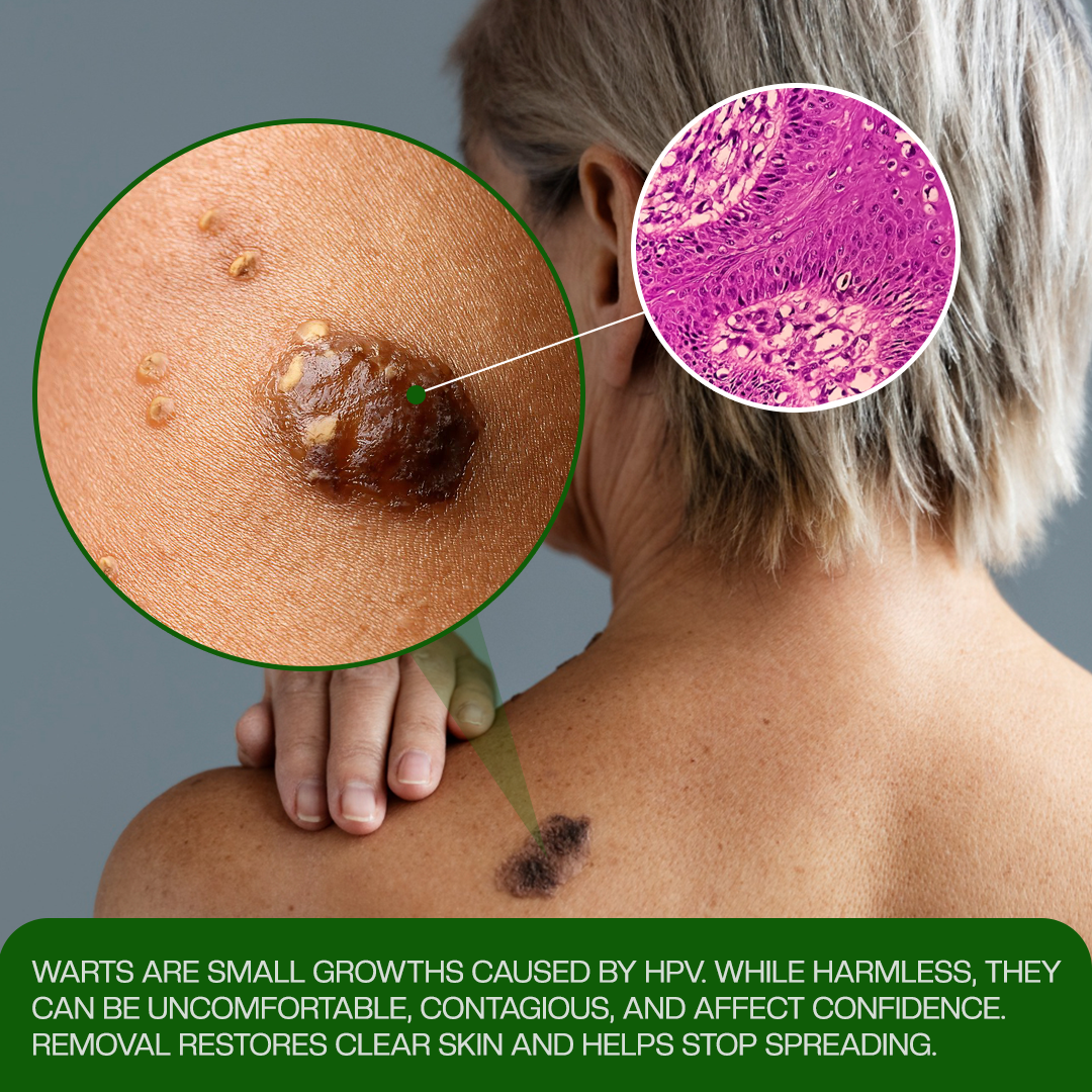 Timilk® ClinixClear Wart Remover Patch⭐